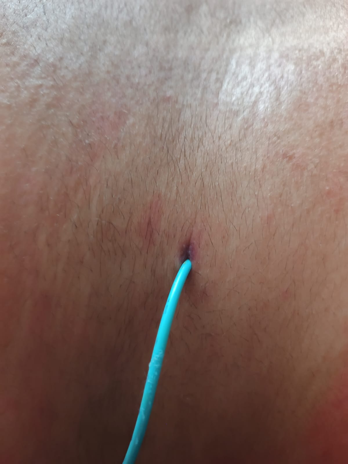 Imagen médica de nefrostomía