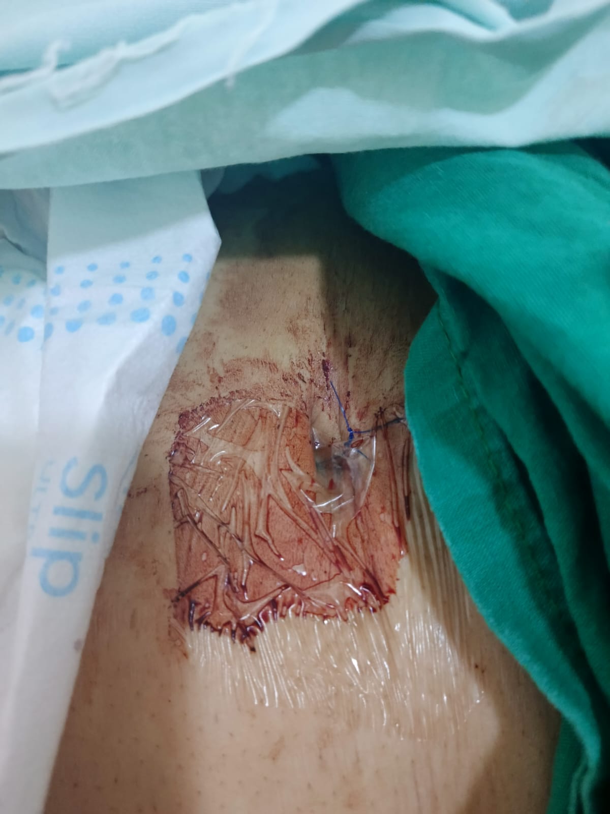 Imagen médica del procedimiento y curación de nefrostomía